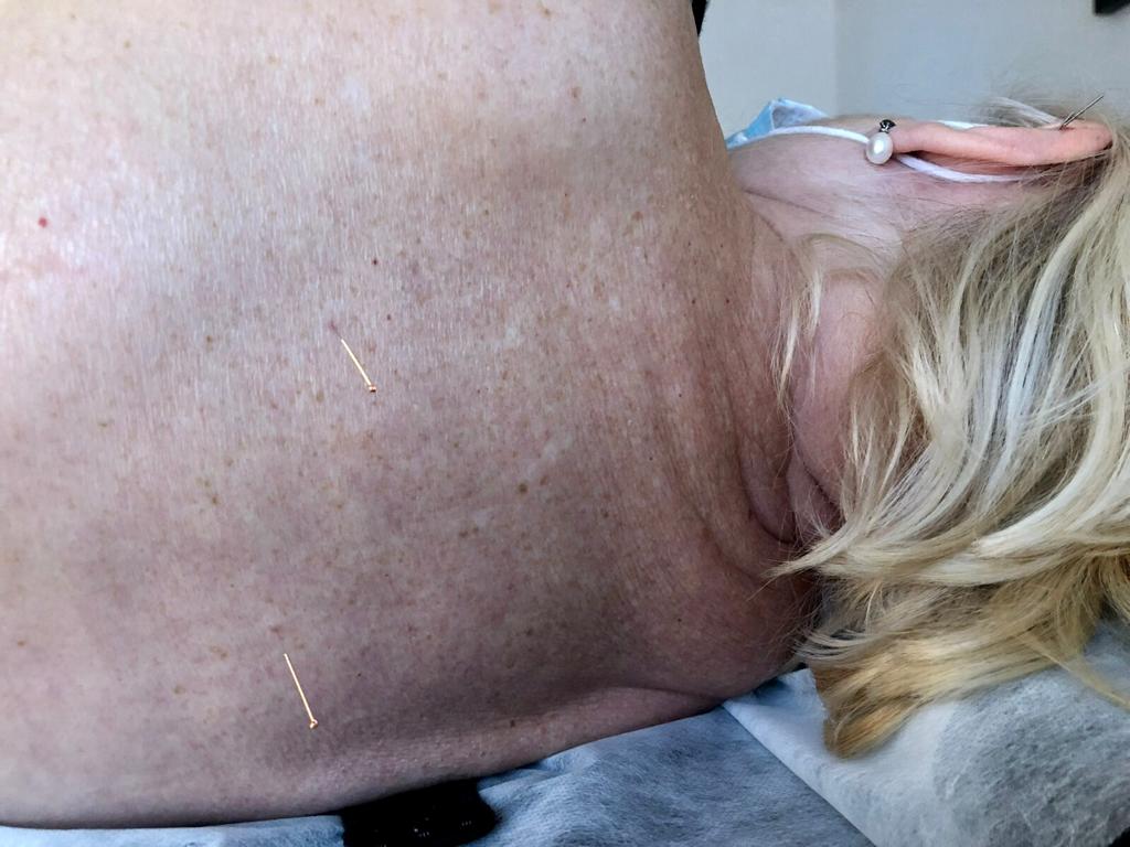 Acupuntura i vida Badalona